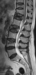 imagen fractura columna vertebral