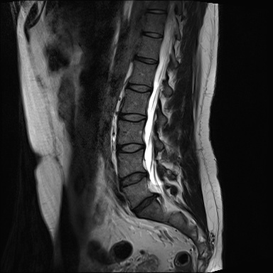 radiografía columna vertebral dolor lumbar