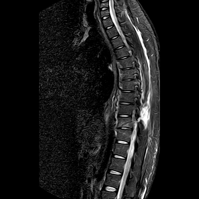 radiografía columna vertebral