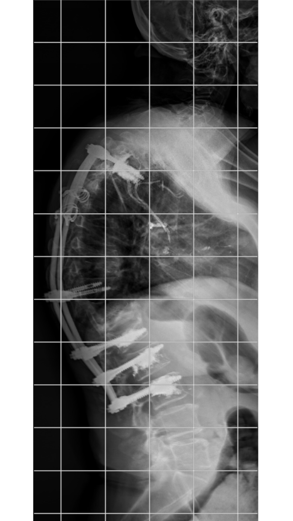 radiografía hombre 78 años tratamiento columna vertebral