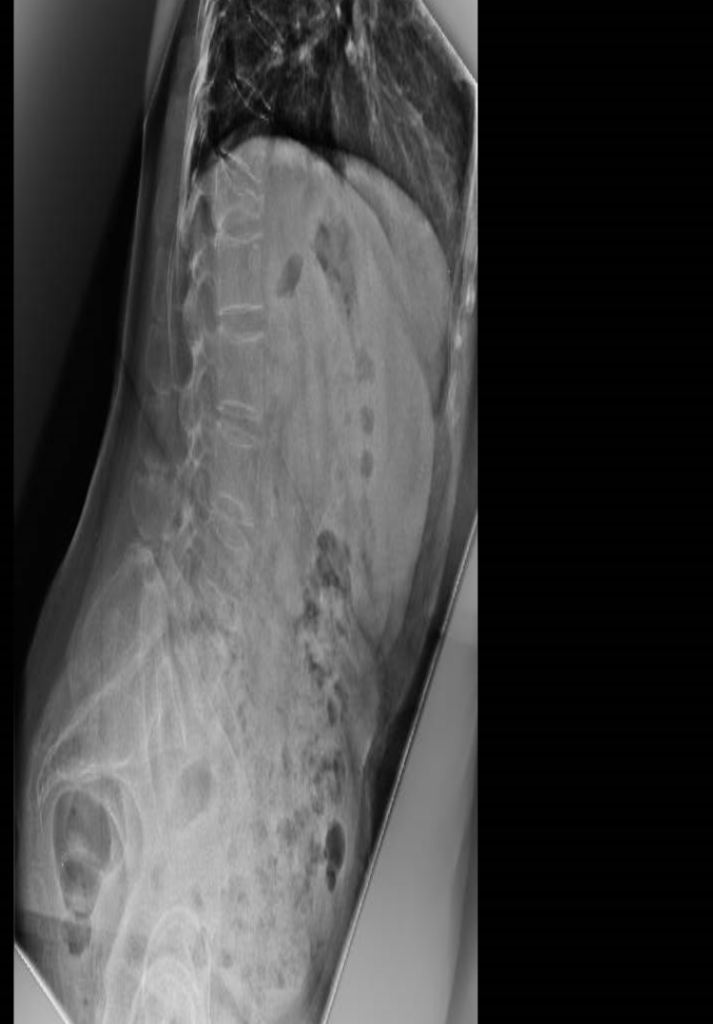 radiografía columna vertebral fractura osteoporótica