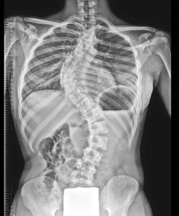 Radiografía escoliosis iacolumna