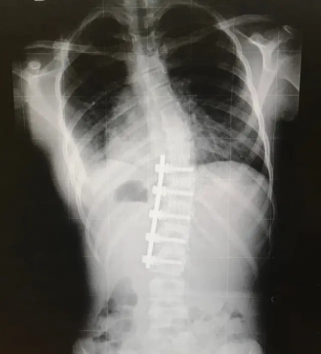 radiografia escoliosis adolescente iacolumna