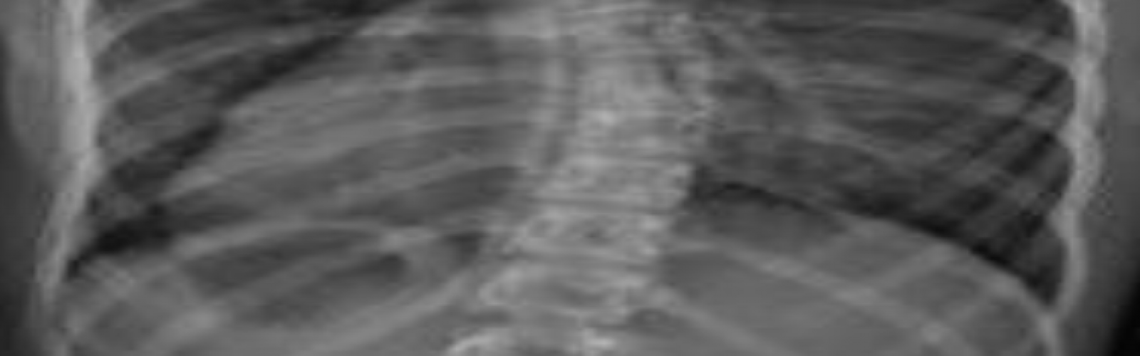 radiografía columna vertebral Cirugía de Escoliosis