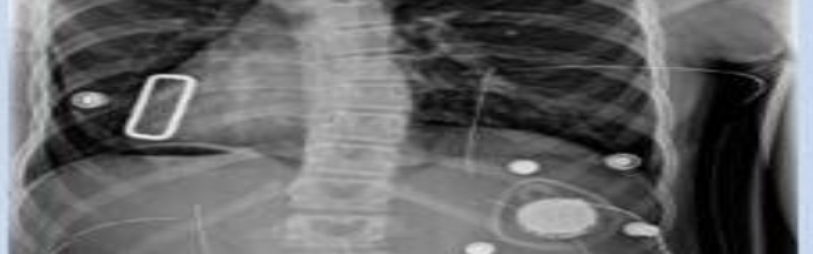 radiografía corsé tratamiento columna vertebral