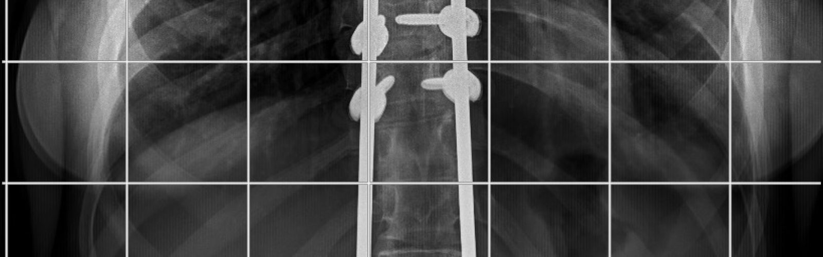 radiografía columna vertebral